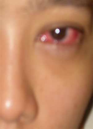 Red-eyed Ummi